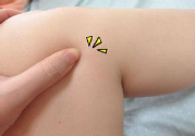 小腿水腫是什么原因引起的？教你輕松解決之道