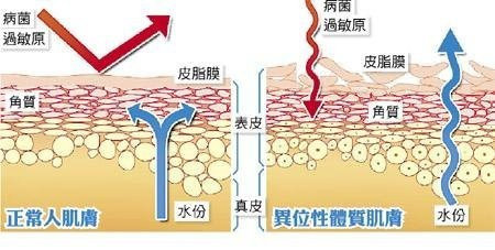 異位性皮炎用什么藥保濕
