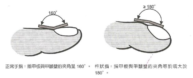 怎樣看出心臟有問題 從手指、舌頭眼神測試