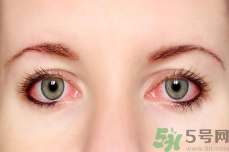 流感咳嗽導(dǎo)致眼睛出血怎么辦?眼睛出血嚴重嗎?