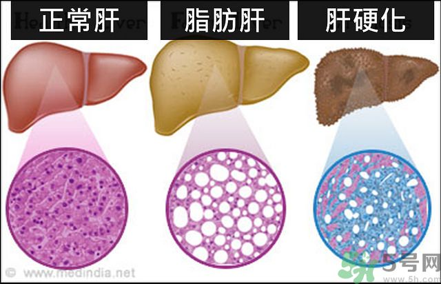 得了脂肪肝該怎么治？脂肪肝對人體危害有多大？