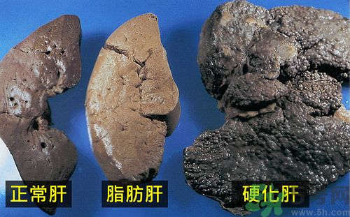 得了脂肪肝該怎么治？脂肪肝對人體危害有多大？