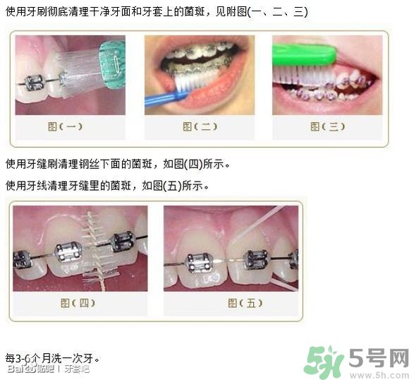 18歲還能戴牙套嗎？戴牙套真的能瘦臉改變臉型嗎？