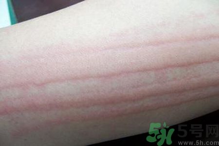 蕁麻疹會(huì)不會(huì)傳染？蕁麻疹怎么治才能好？