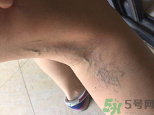 40歲女性小腿靜脈曲張怎么辦？