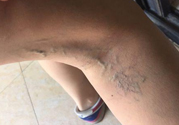 40歲女性小腿靜脈曲張怎么辦？