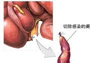 闌尾手術(shù)會(huì)影響結(jié)腸嗎？闌尾手術(shù)術(shù)后要注意什么？