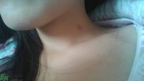 種草莓吻痕是什么意思？吻痕是怎么弄出來(lái)的？