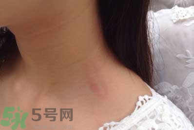 種草莓吻痕是什么意思？吻痕是怎么弄出來(lái)的？
