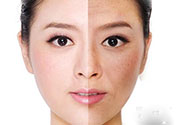 激光美白有用嗎？激光美白可以維持多久？