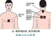 腰痛貼三伏貼有用嗎？腰痛三伏貼貼哪個(gè)穴位？