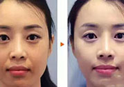 激光美白多少錢？激光美白價(jià)格