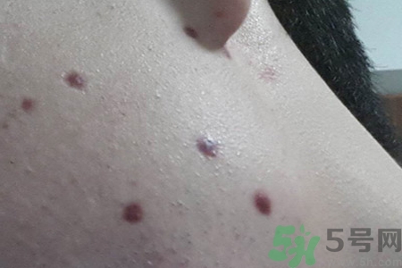 激光點(diǎn)痣后可以洗臉嗎？激光點(diǎn)痣后需要注意什么？