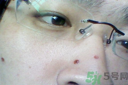 激光點(diǎn)痣后可以洗臉嗎？激光點(diǎn)痣后需要注意什么？