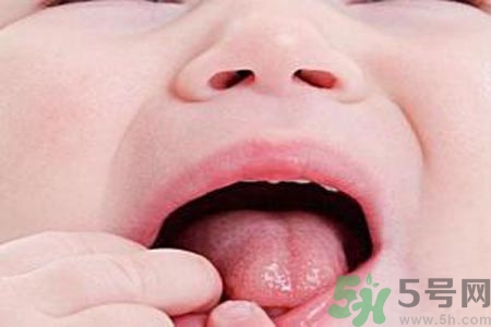 寶寶口腔潰瘍怎么辦？治療寶寶口腔潰瘍方法有什么？