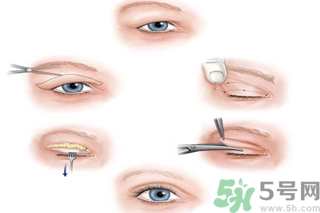 割雙眼皮分哪幾種？割雙眼皮需要多少錢？