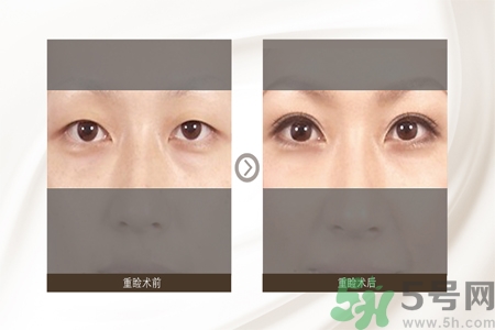 割雙眼皮分哪幾種？割雙眼皮需要多少錢(qián)？