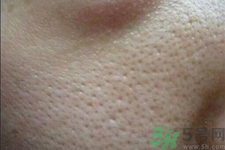 皮膚毛孔粗大原因有哪些？如何預(yù)防皮膚毛孔粗大？
