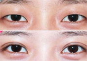 割雙眼皮分哪幾種？割雙眼皮需要多少錢？