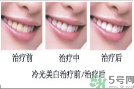 冷光美白牙齒是什么？冷光美白牙齒的好處有哪些？