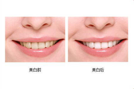 冷光美白牙齒可以保持多長時間？冷光美白牙齒有副作用嗎？