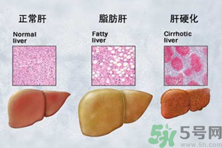 妊娠急性脂肪肝是什么？妊娠急性脂肪肝的治療方法？