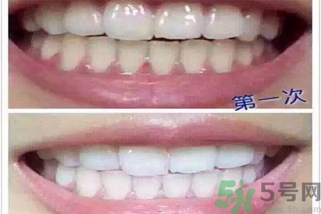 冷光美白牙齒的價(jià)格是多少？做冷光美白牙齒需要多少錢？