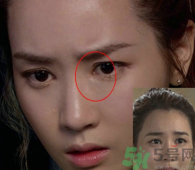 開眼角多少錢？開眼角有什么危害？