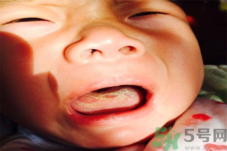 舌頭燙傷后該怎么辦呢？舌頭燙傷后應(yīng)該注意吃什么？?