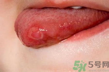舌頭長泡怎么辦？舌頭長泡的原因？