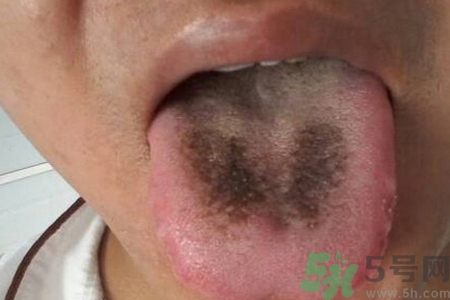 舌頭發(fā)黑怎么回事？舌頭發(fā)黑怎么辦？