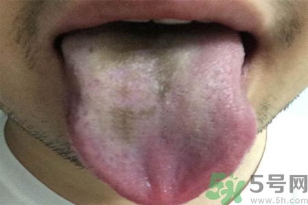 舌頭發(fā)黑怎么回事？舌頭發(fā)黑怎么辦？
