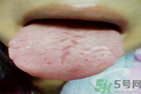 舌頭上有裂紋是怎么辦？舌頭上有裂紋是什么原因？