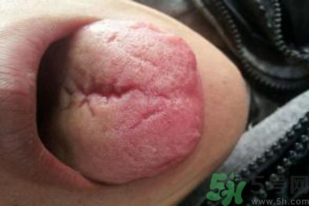舌頭上有裂紋是怎么辦？舌頭上有裂紋是什么原因？