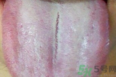 舌頭發(fā)白是什么原因？舌苔發(fā)白是怎么辦？