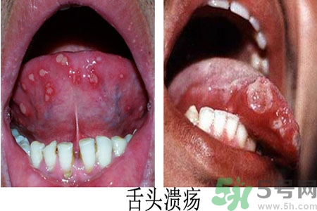 舌頭潰瘍?cè)趺崔k？舌頭潰瘍的原因？