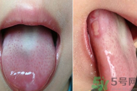舌頭潰瘍?cè)趺崔k？舌頭潰瘍的原因？