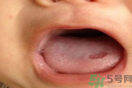舌頭潰瘍怎么辦？舌頭潰瘍的原因？