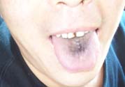 舌頭發(fā)黑怎么回事？舌頭發(fā)黑怎么辦？