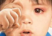 寶寶得了紅眼病怎么辦？寶寶得了紅眼病怎么治？
