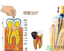 什么是根管治療？為什么牙齒疼要做根管治療？