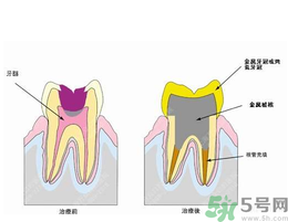 什么是根管治療？為什么牙齒疼要做根管治療？
