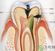 什么是根管治療？為什么牙齒疼要做根管治療？