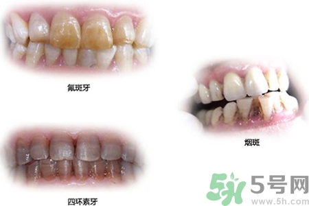 四環(huán)素牙是什么？四環(huán)素牙是怎么形成的？
