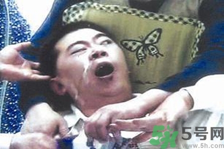 癲癇的典型癥狀有哪些？癲癇是什么？