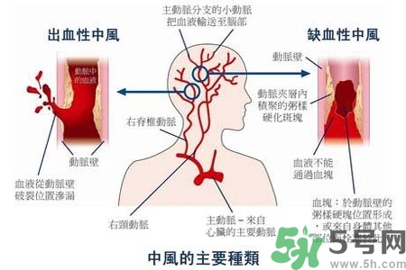 腦中風是什么？腦中風的癥狀？