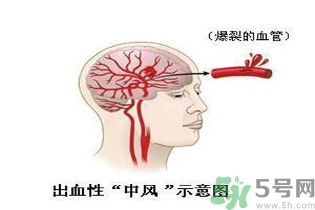 腦中風(fēng)的護(hù)理措施？腦中風(fēng)的飲食護(hù)理？