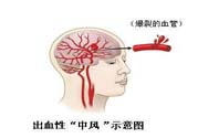 腦中風的發(fā)病因素？腦中風的并發(fā)癥有哪些 ？
