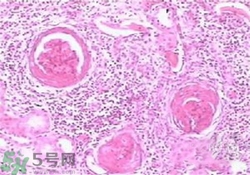 慢性腎炎能治好嗎？慢性腎炎能活多久？