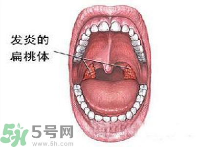 慢性咽炎是什么？慢性咽炎的癥狀有哪些？